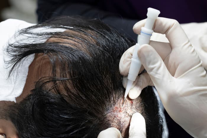 Hair Transplant Turkey – Skilled Surgeons, Natural Hair Growth