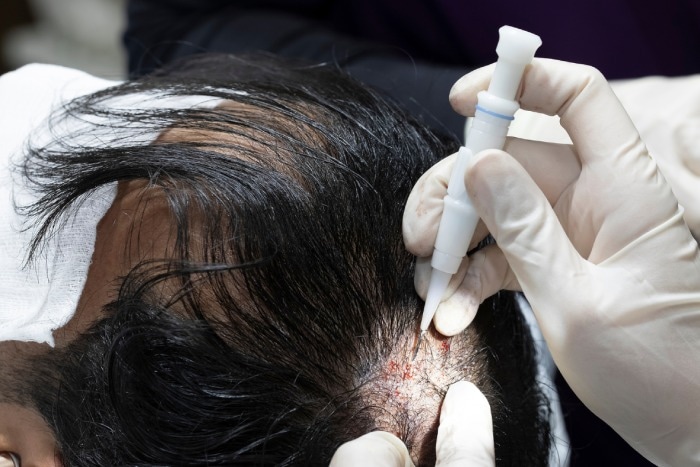 Hair Transplant Turkey – Skilled Surgeons, Natural Hair Growth