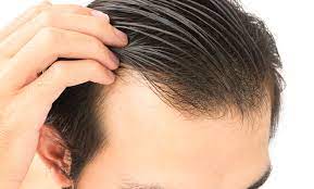 Hair Transplant Turkey: Leading Surgeons and Modern Techniques