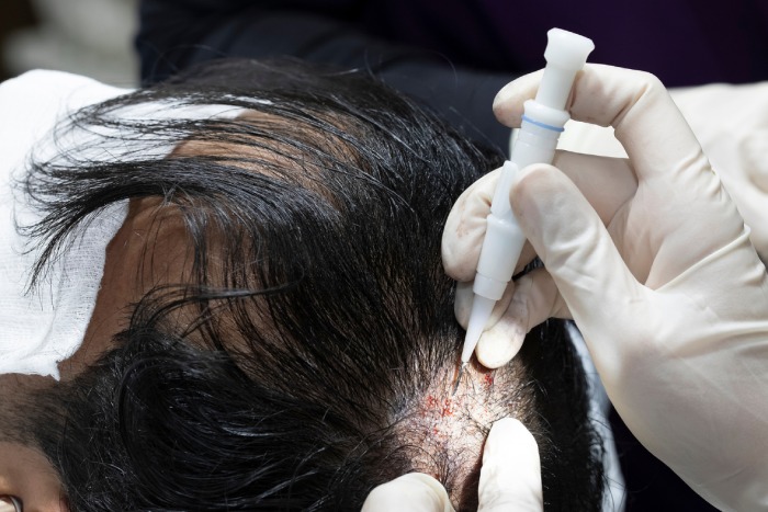 Hair Transplant Turkey – Skilled Surgeons, Natural Hair Growth