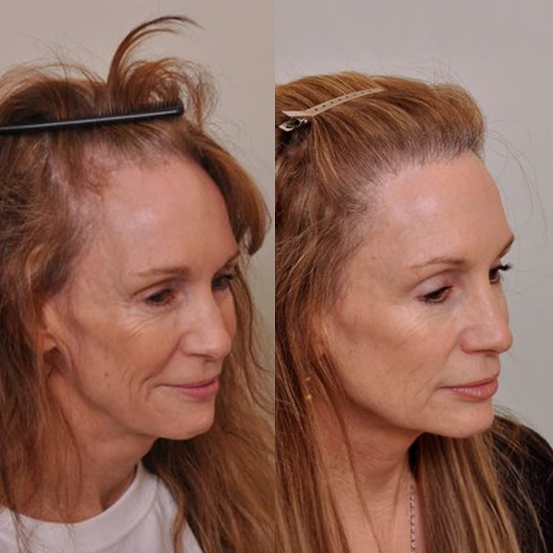 Best Hair Transplant London – See Our Before & After Results